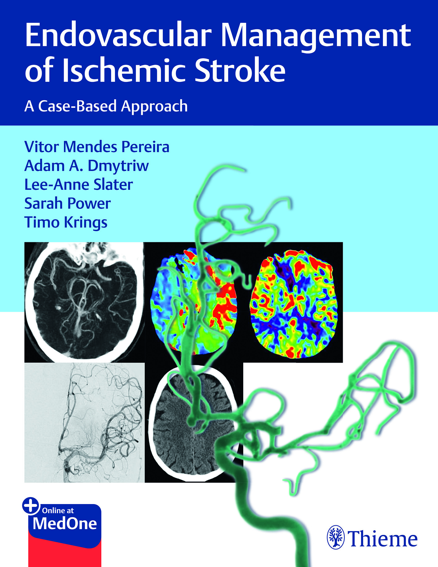 Endovascular Management of Ischemic StrokeCase-Based Approach