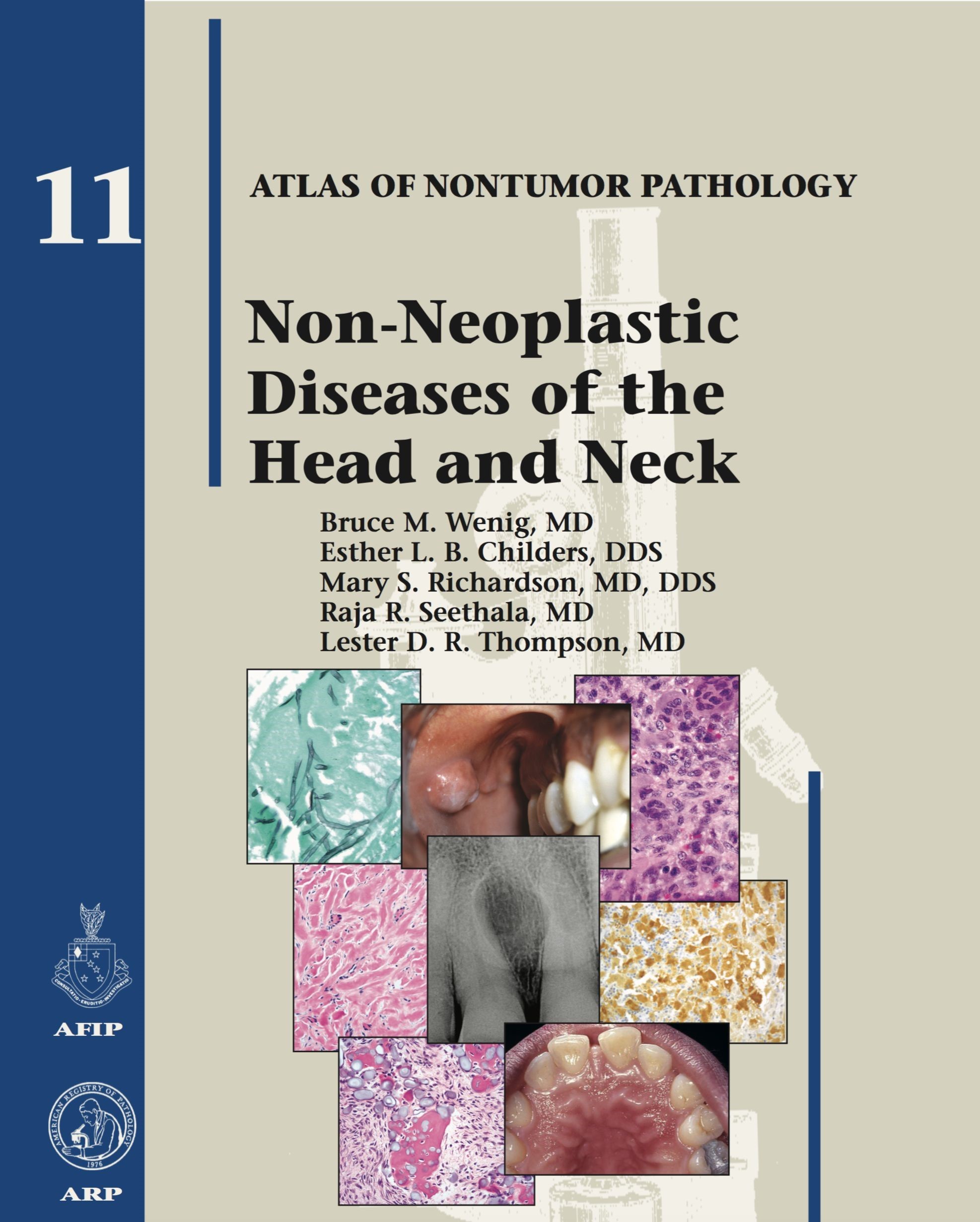 Atlas of Nontumor Pathology, Fascicle 11- Non-Neoplastic Diseases of Head & Neck