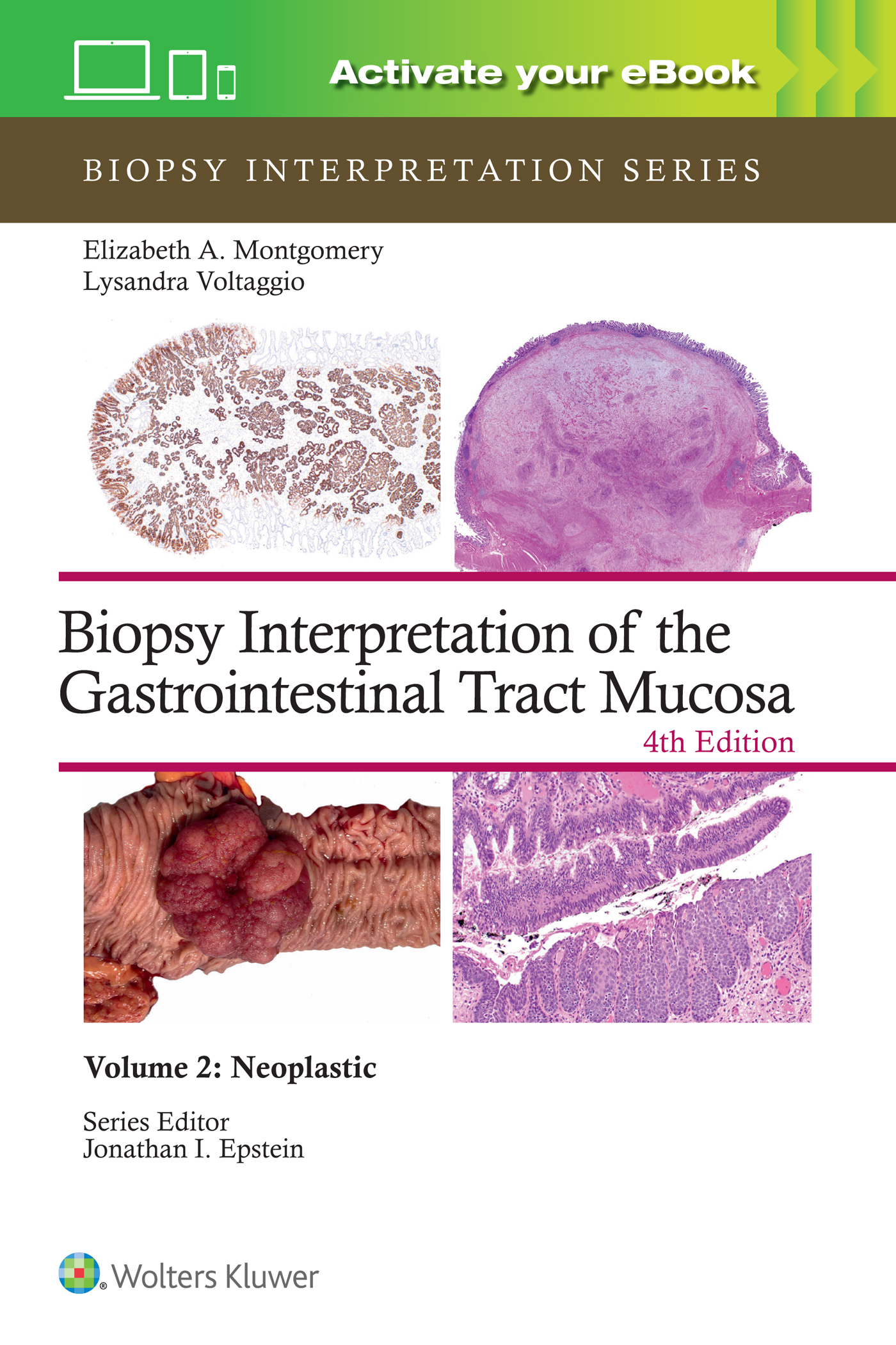 Biopsy Interpretation of the Gastrointestinal TractMucosa, 4th ed.Vol.2: Neoplastic