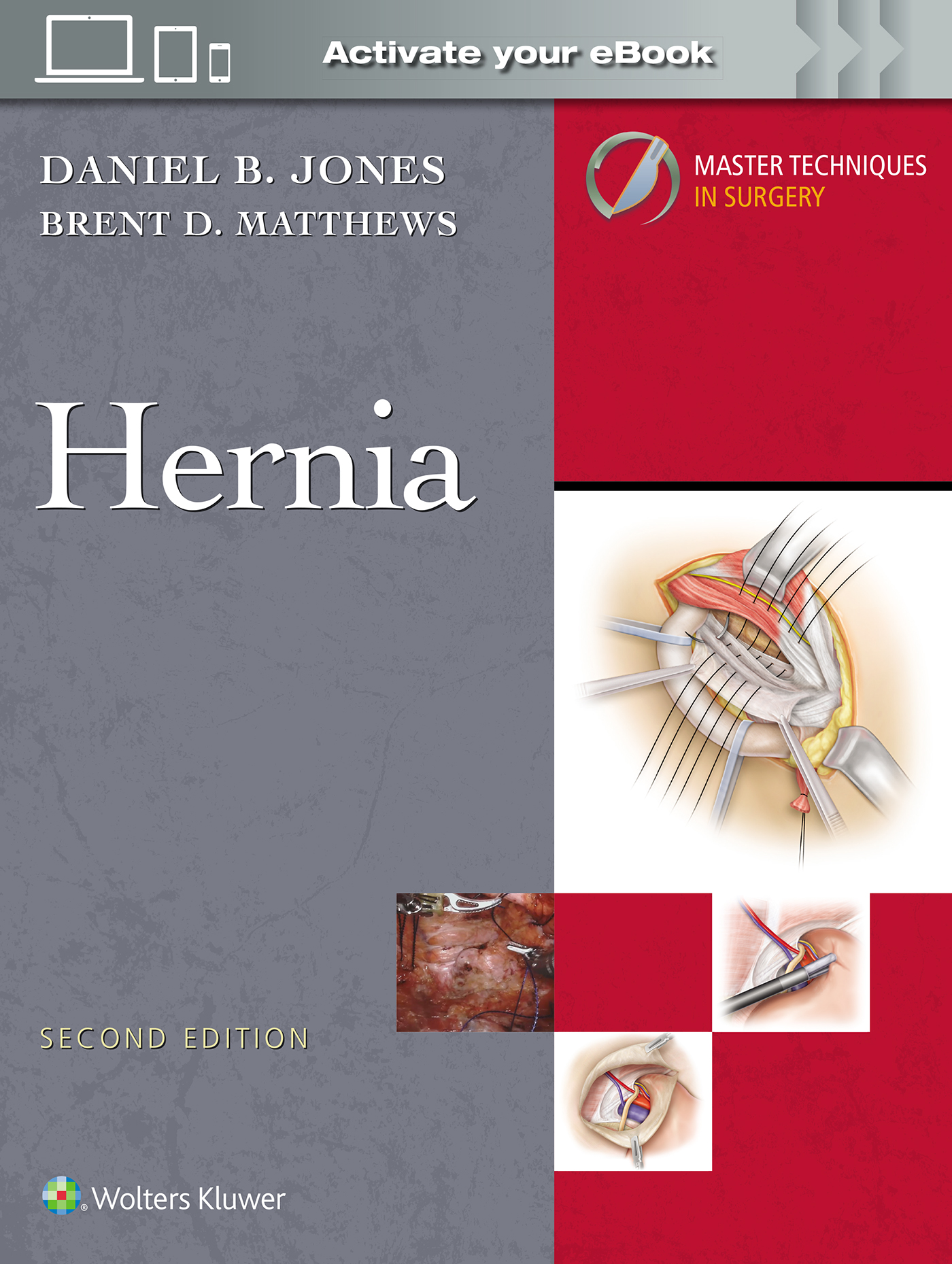 Master Techniques in Surgery: Hernia, 2nd ed.