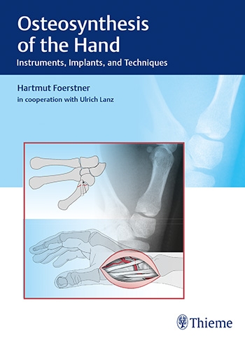 Osteosynthesis of the Hand- Instruments, Implants & Techniques