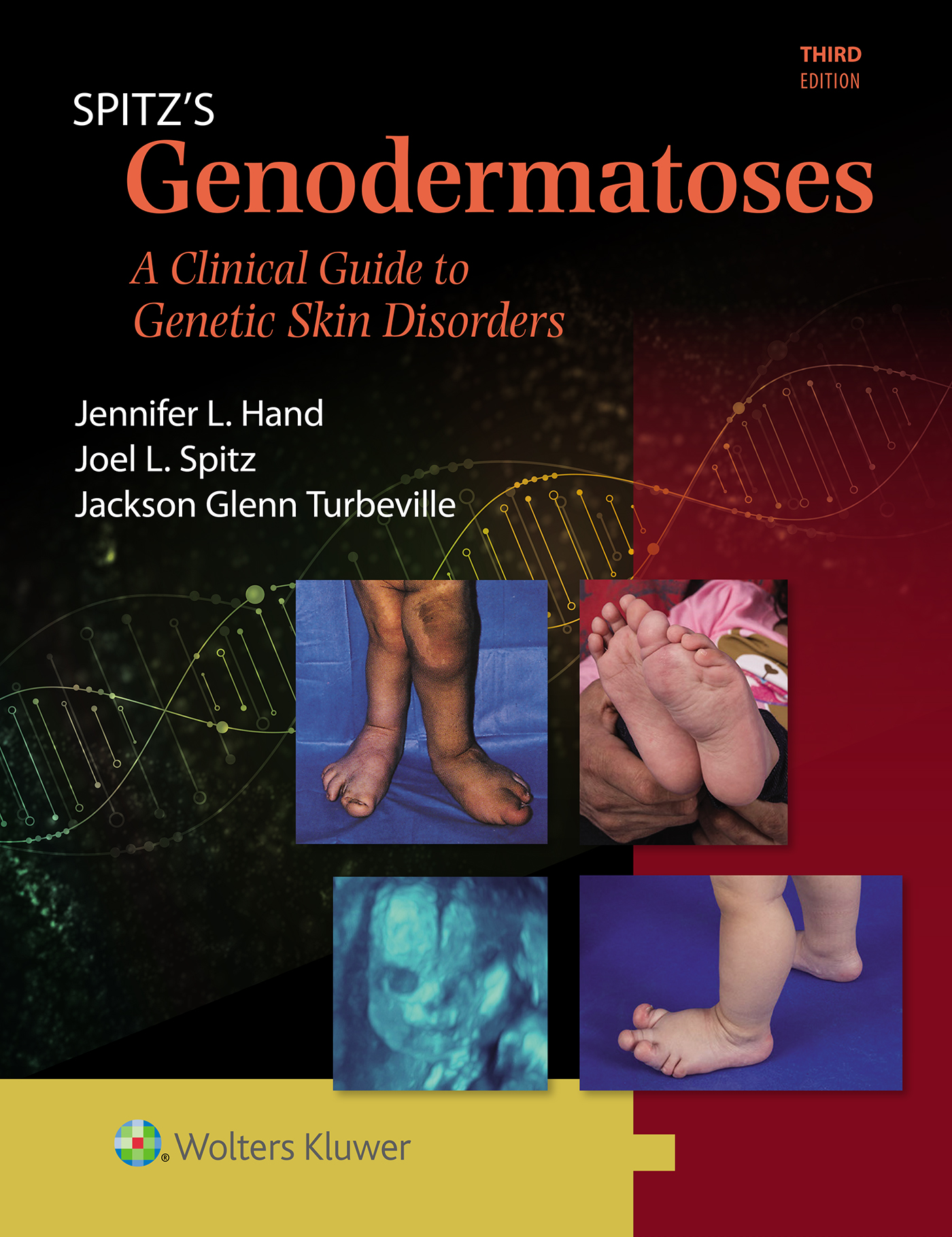 Spitz's Genodermatoses, 3rd ed.- A Clinical Guide to Genetic Skin Disorders