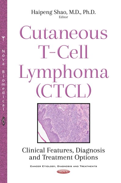 Cutaneous T-Cell Lymphoma (Ctcl)- Clinical Features, Diagnosis and Treatment Options