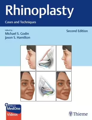 Rhinoplasty, 2nd ed.- Cases & Techiques