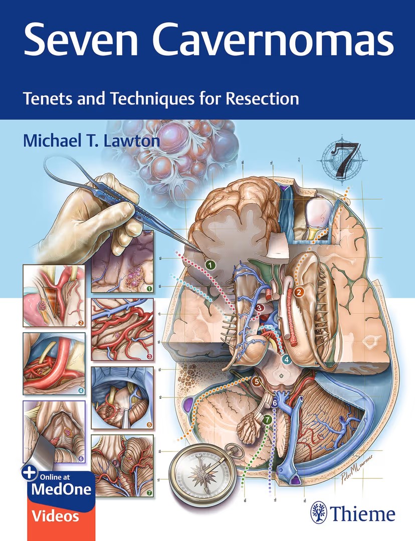 Seven Cavernomas- Tenets & Techniques for Resection