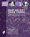 Bone & Soft Tissue Tumors- A Multidisciplinary Review with Case Presentations