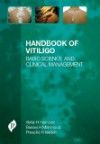 Handbook of Vitiligo- Basic Science & Clinical Management