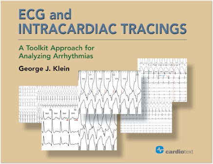 ECG & Intracardiac Tracings- A Toolkit Approach for Analyzing Arrhythmias